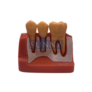 Tooth Study Model – Implant / Crown